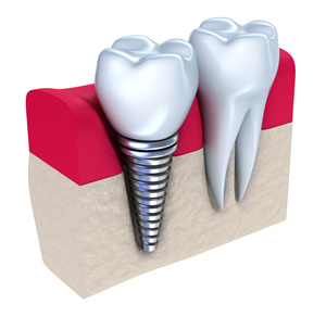 dental implants tempe az