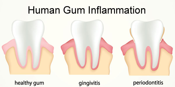 Human Gum Inflammation